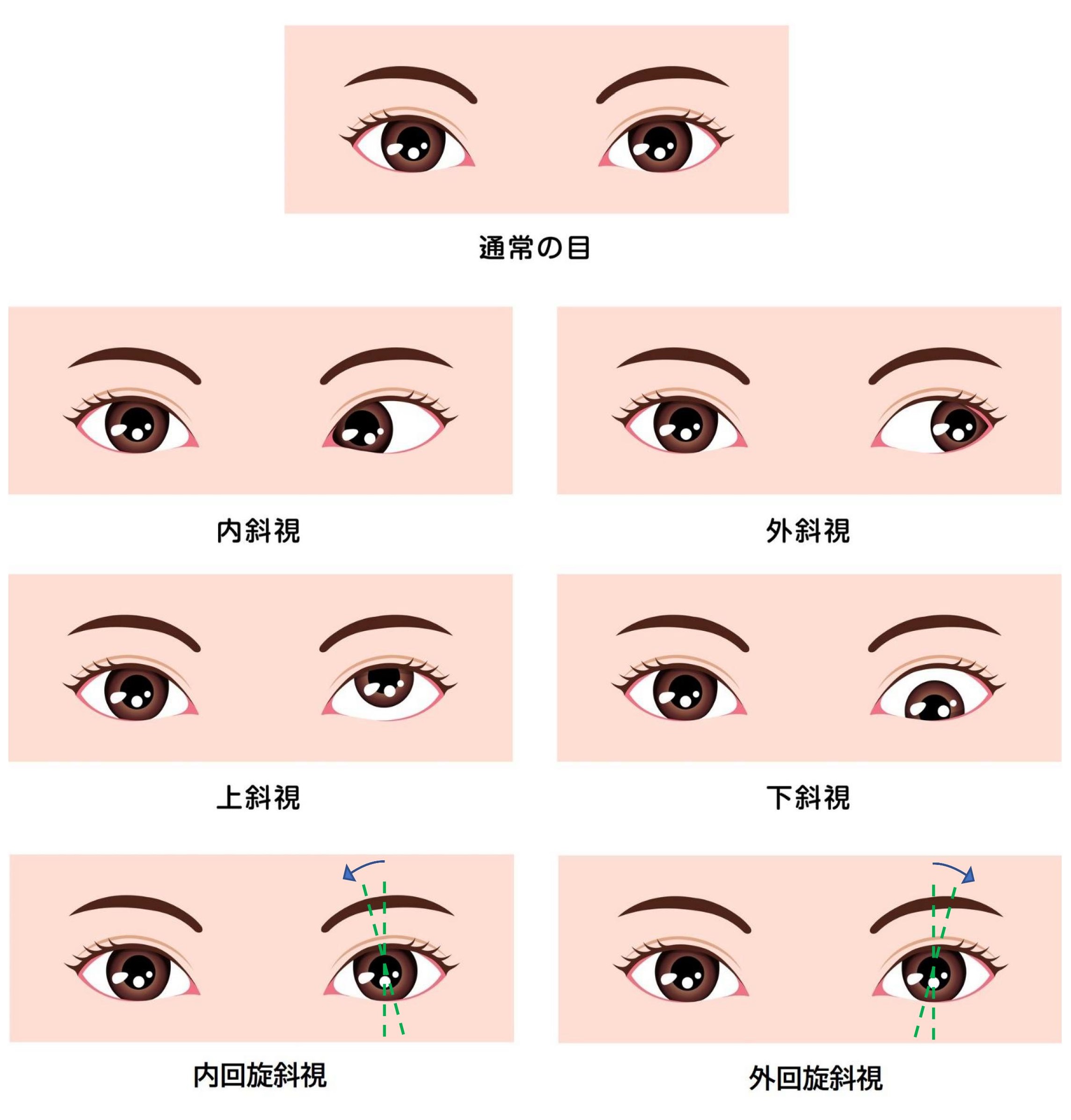 プリズム 斜視: 斜視 見え方 本人 – SQVS